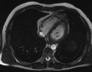 An MRI (Magnetic Resonance Image) of the human heart