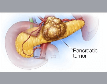 An illustration of a pancreatic tumor on the pancreas
