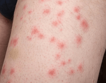 A picture of bed bug bites on an arm