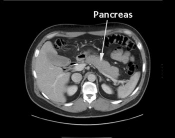 A computed tomography scan (CT Scan) of the pancreas