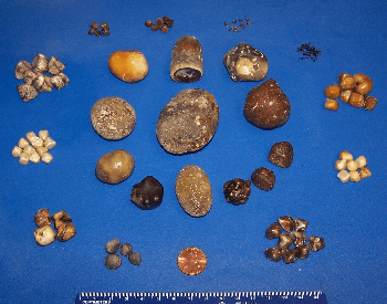 An image of gallstones from a human gallbladder