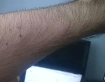 A picture of hair on the human forearm