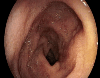 A picture showing the inside of an esophagus