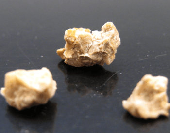 An image of human kidney stones