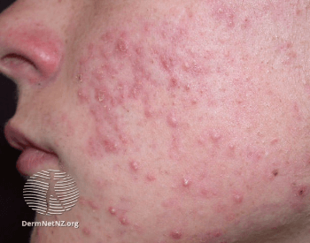 A picture of a human face with acne vulgaris