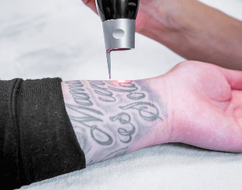 A picture of a tattoo being removed from a wrist