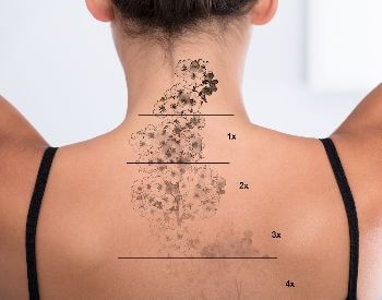 A picture of tattoo removal treatments over time