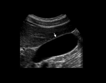 An ultrasound picture of the human gallbladder