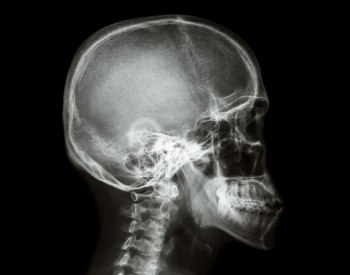 A picture of human skull bones in an x-ray picture