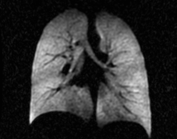 An MRI (Magnetic Resonance Image) of the human lungs