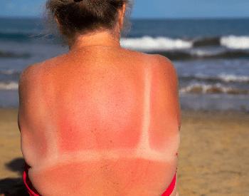 A picture of a woman with sunburn from UV exposure
