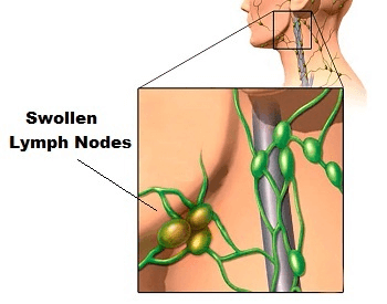 A diagram showing what swollen lymph nodes look like