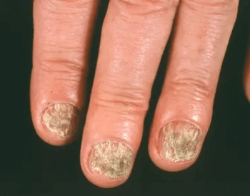 A picture of fingernail fungus
