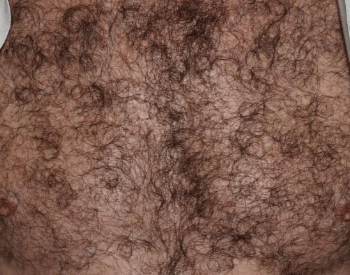 A picture of hair on the human chest