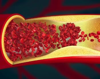 An illustration of blood cells blocked in a heart artery