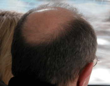 A picture of male pattern baldness