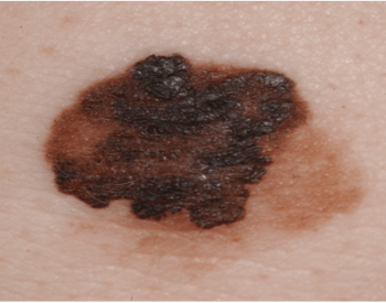 A picture of melanoma skin cancer from UV exposure