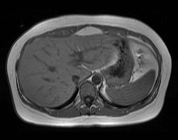 A Magnetic resonance imaging (MRI) image of the liver