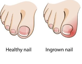 A picture of a normal toenail verus an ingrown toenail
