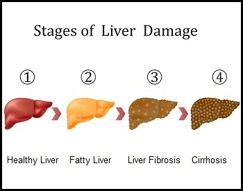 A diagram of the stages of liver disease