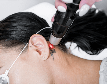 A picture of a tattoo being removed from a neck