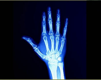 A picture of an x-ray of a hand