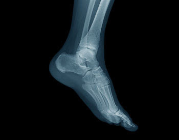 A picture of human foot bones in an x-ray picture