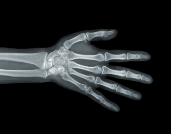 A picture of human hand bones in an x-ray picture