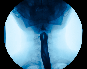 A picture of an x-ray of the upper esophagus